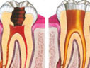 Canal (Endodontia) sem tratamento de canal
