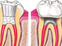 Canal (Endodontia) com tratamento de canal