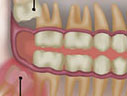 Cirurgia terceiro molar