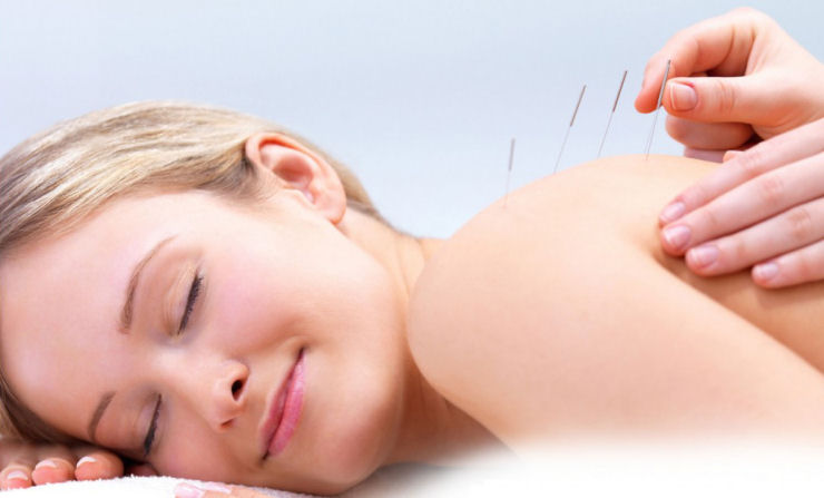 Acupuntura