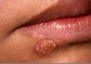 Herpes bucal