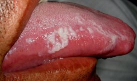 leocoplasia