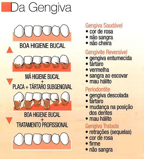 Gengiva E Os Problemas
