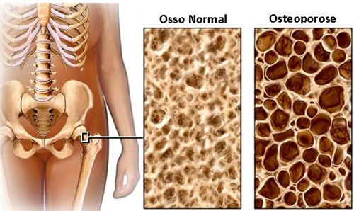 Osteoporose01