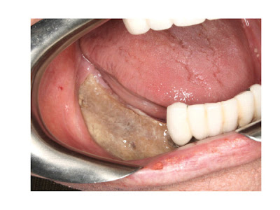Osteonecrose Mandibular