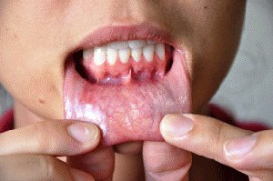 11 Prevencao Cancer Bucal Site S300