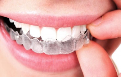 Moldeira -clareamento -dental -caseiro